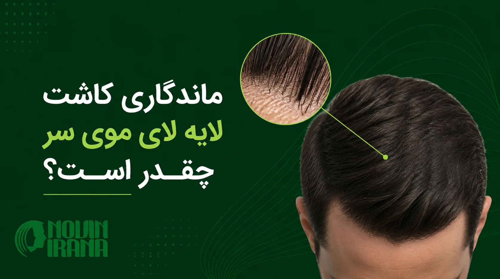 ماندگاری کاشت لابه لای موی سر چقدر است؟